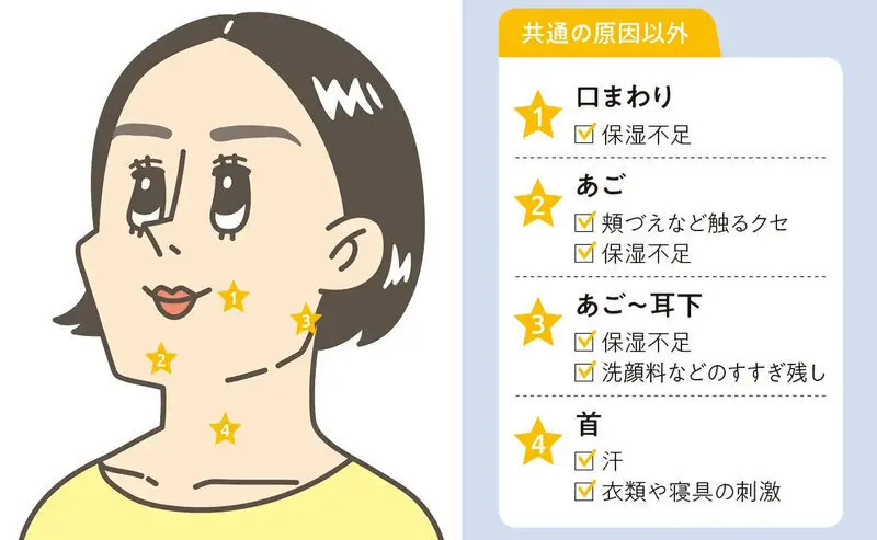 ニキビができる場所　基本の原因以外　イラスト