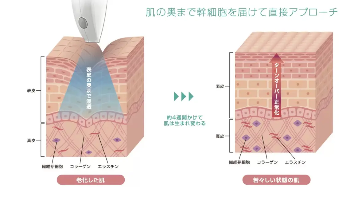 HIFU(ハイフ)に代わる最新肌管理？！の画像_2